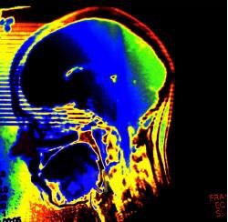 ondes-portables-maladie-d8217alzheimer-L-1